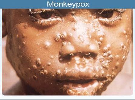 Things You Need To Know About MonkeyPox Virus