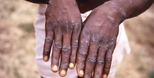 Facts about Monkeypox 