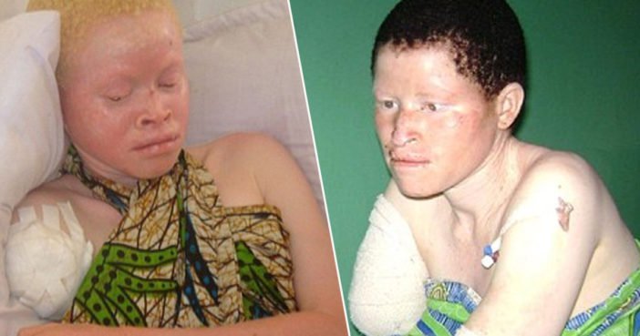 Albinos In Tanzania Are Being Hunted For Their Limbs