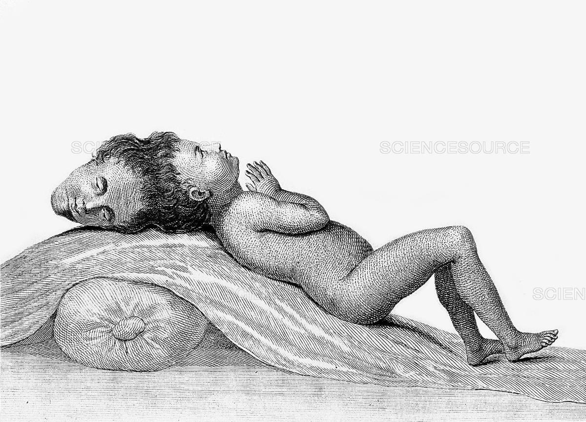 The Two-Headed Boy of Bengal: His Life, and Early Death 